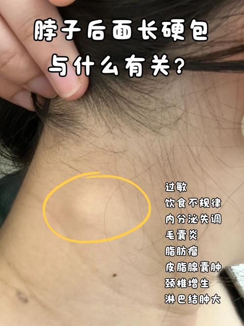 硬颈是什么生肖,硬颈是什么原因造成的